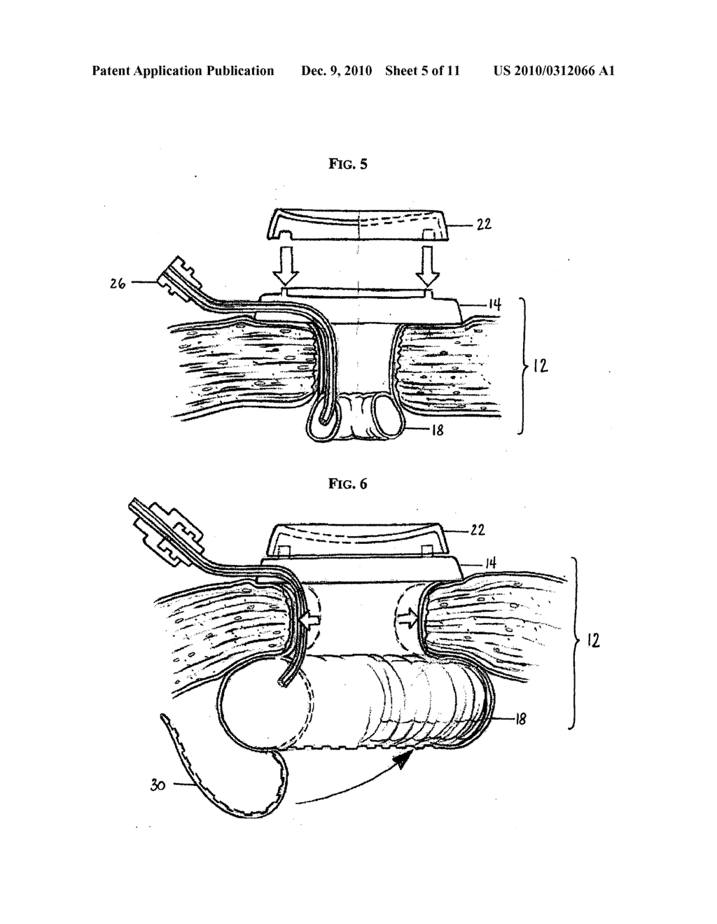 INFLATABLE RETRACTOR WITH INSUFFLATION - diagram, schematic, and image 06