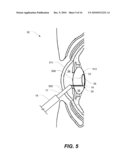 Capsulotomy Repair Device and Method for Capsulotomy Repair diagram and image