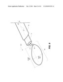 Capsulotomy Repair Device and Method for Capsulotomy Repair diagram and image