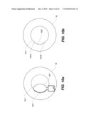 Capsulotomy Repair Device and Method for Capsulotomy Repair diagram and image