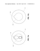 Capsulotomy Repair Device and Method for Capsulotomy Repair diagram and image