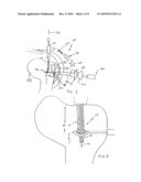 Surgical Drill Guide With Awl and Method of Use diagram and image