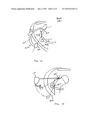 Surgical Drill Guide With Awl and Method of Use diagram and image