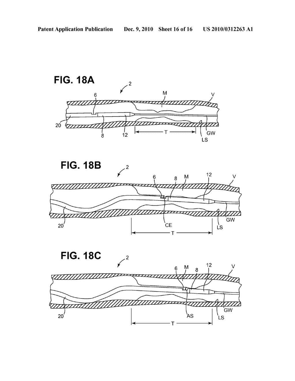 METHODS AND DEVICES FOR CUTTING AND ABRADING TISSUE - diagram, schematic, and image 17