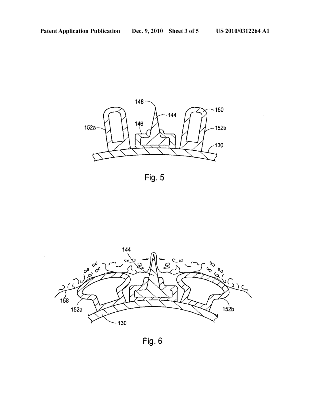 CUTTING BALLOON HAVING SHEATHED INCISING ELEMENTS - diagram, schematic, and image 04