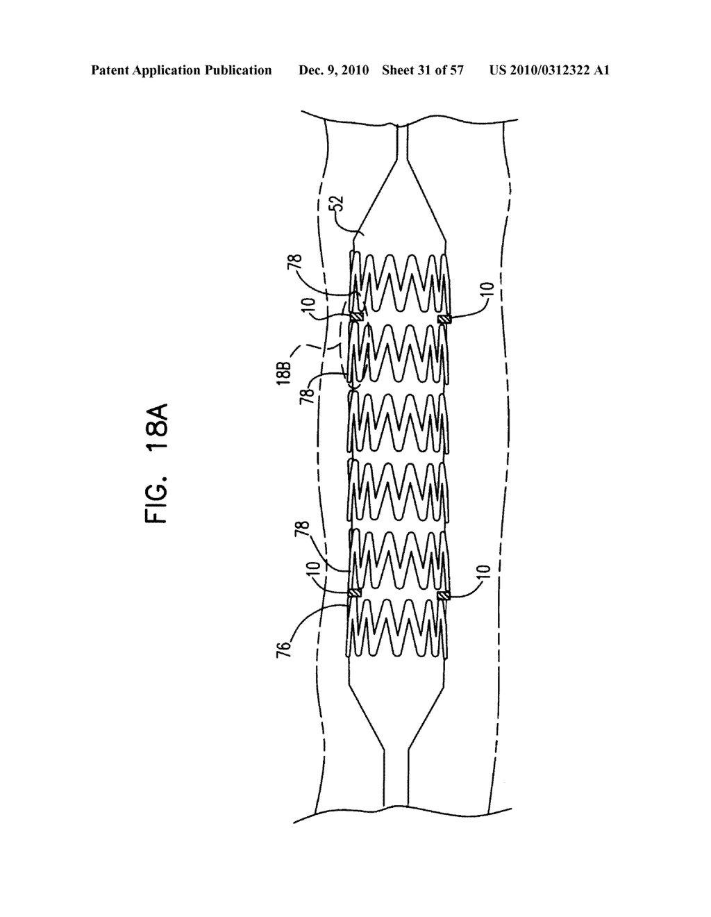 Medical Balloon Incorporating Electroactive Polymer and Methods of Making and Using the Same - diagram, schematic, and image 32