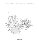 Optically Coupled Active Ossicular Replacement Prosthesis diagram and image