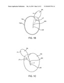 Optically Coupled Active Ossicular Replacement Prosthesis diagram and image