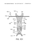 Optically Coupled Active Ossicular Replacement Prosthesis diagram and image