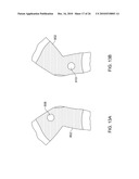 Method and Apparatus for Connective Tissue Treatment diagram and image