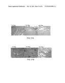 Method and Apparatus for Connective Tissue Treatment diagram and image