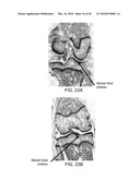 Method and Apparatus for Connective Tissue Treatment diagram and image