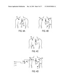 Devices and Methods for Endovascular Electrography diagram and image