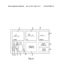 Devices and Methods for Endovascular Electrography diagram and image