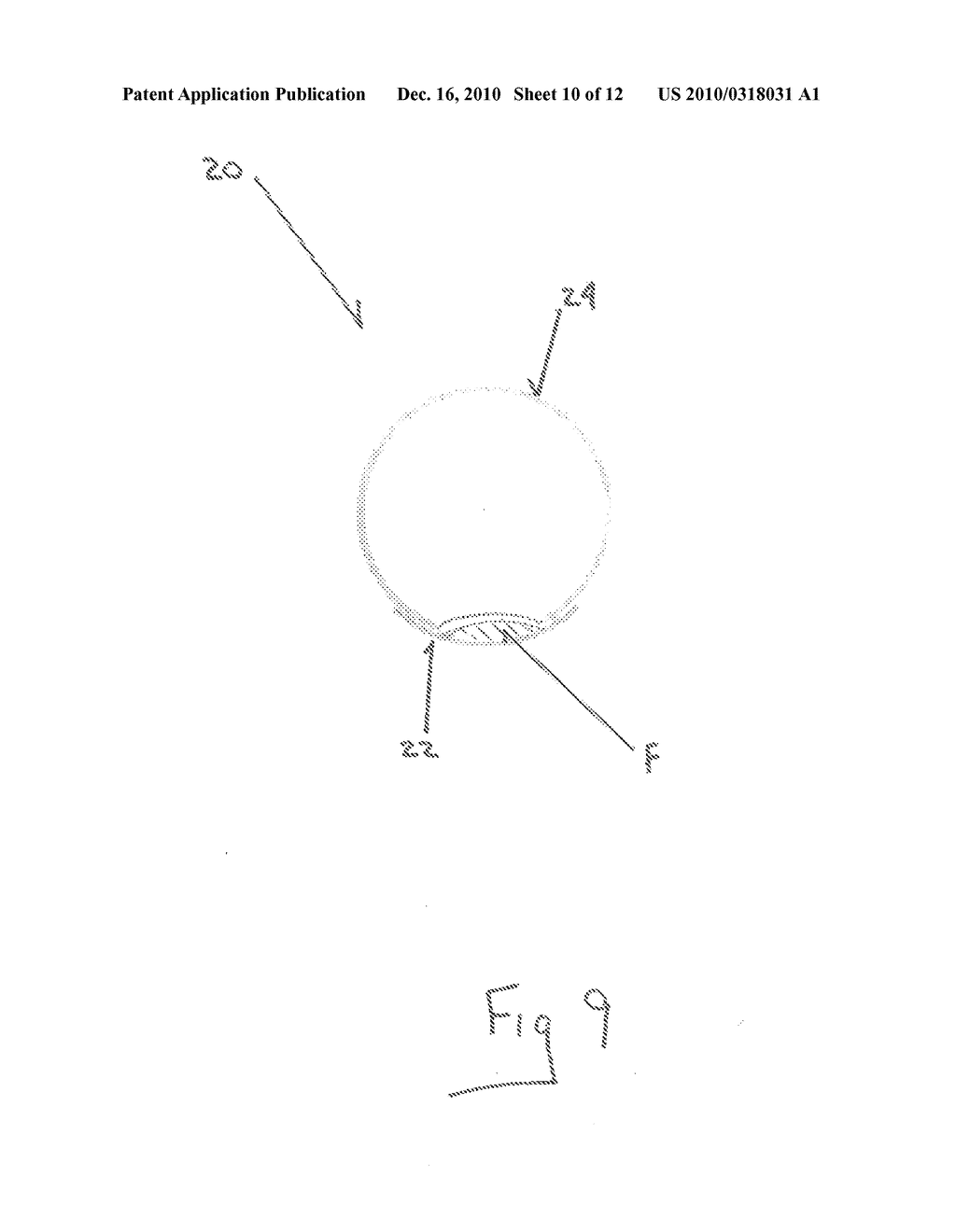 External Stylette Needle and Method of Use - diagram, schematic, and image 11