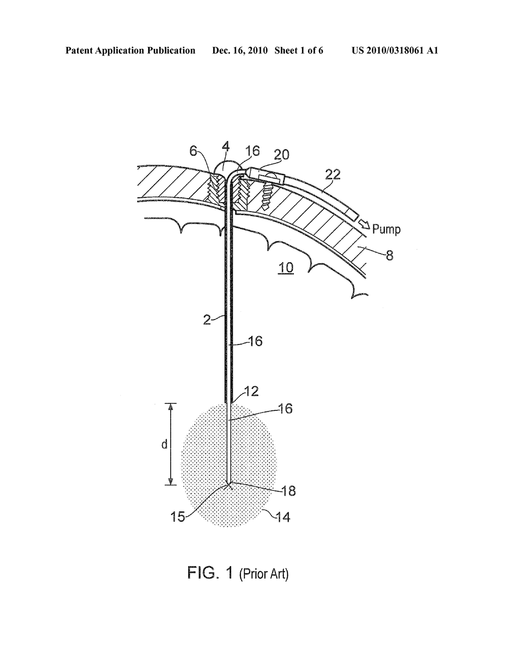 Catheter - diagram, schematic, and image 02