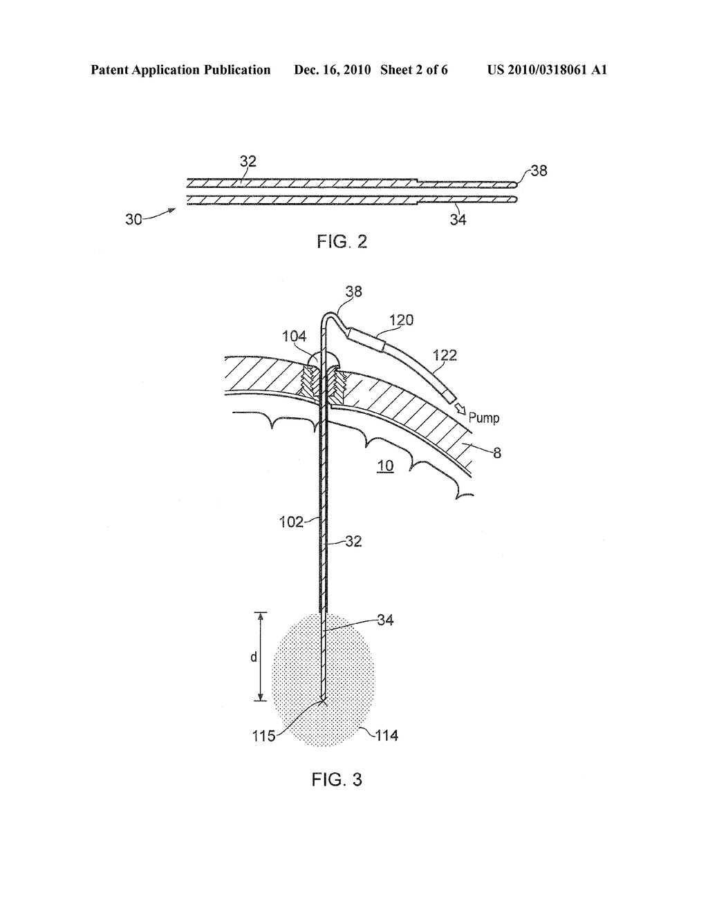 Catheter - diagram, schematic, and image 03