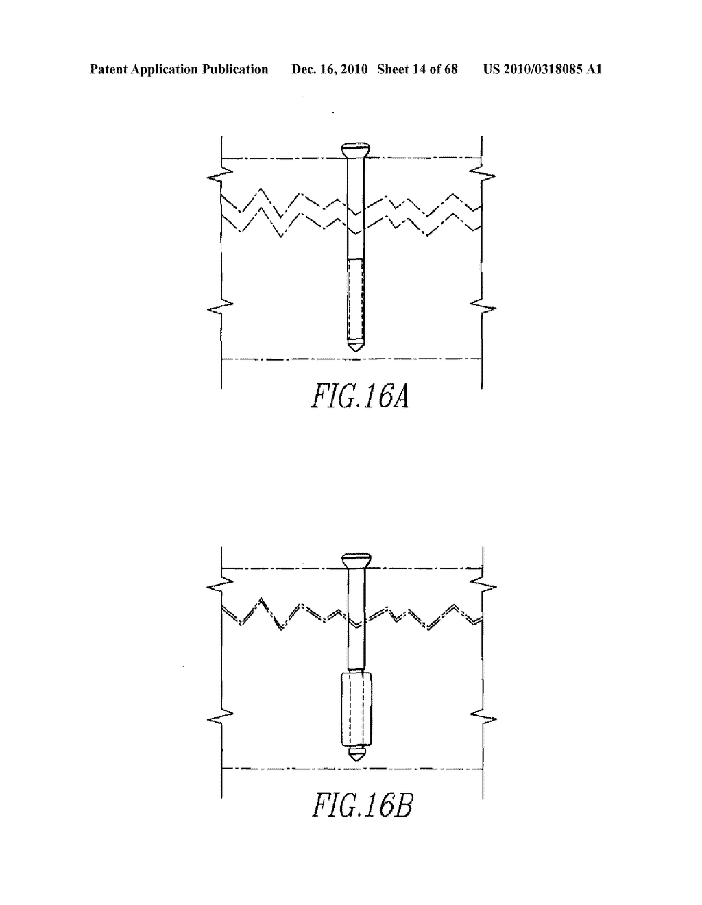 INTERNAL FIXATION DEVICES - diagram, schematic, and image 15