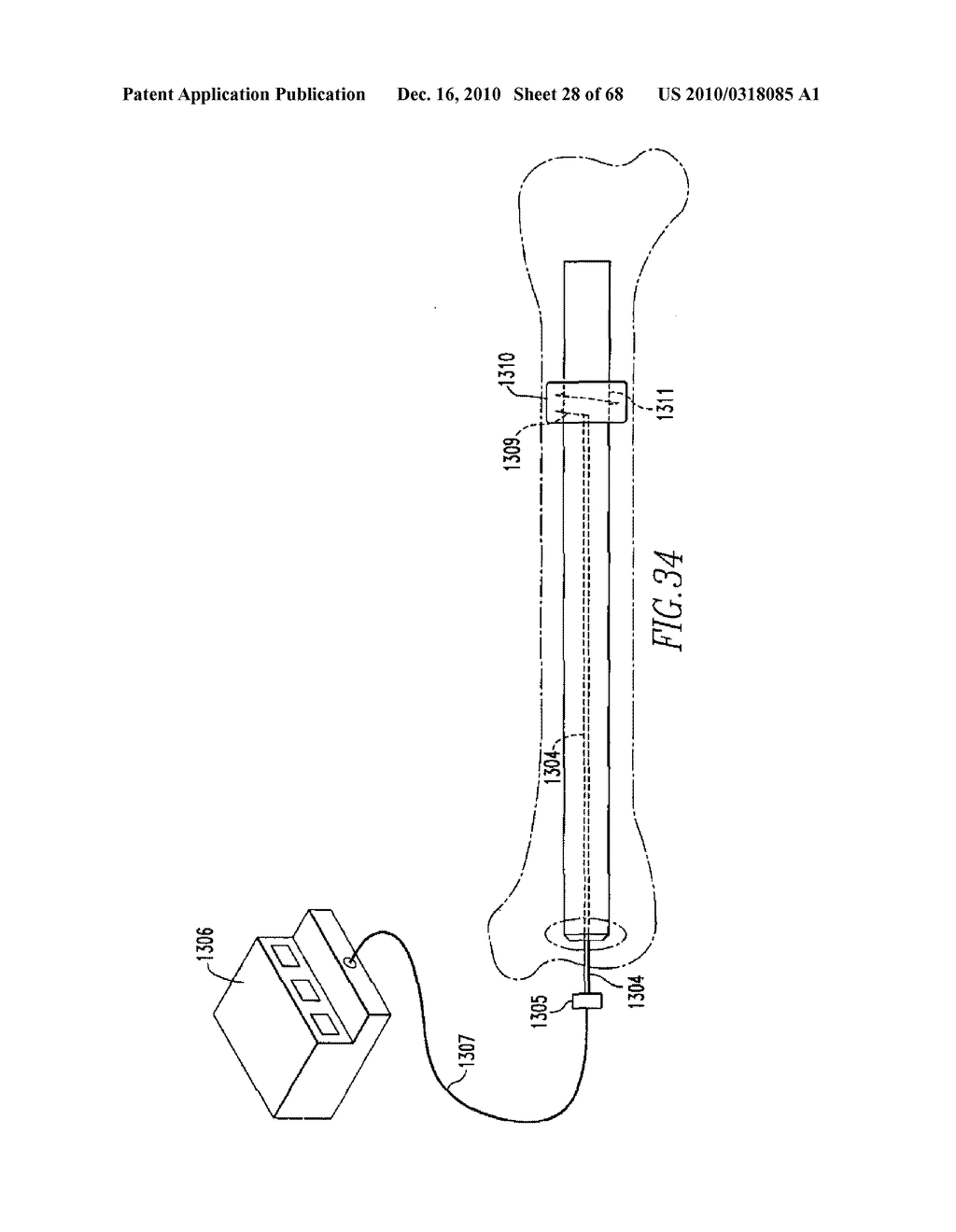 INTERNAL FIXATION DEVICES - diagram, schematic, and image 29