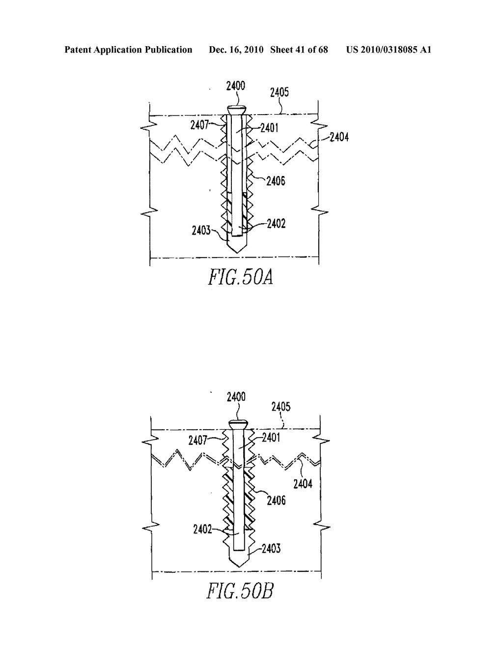 INTERNAL FIXATION DEVICES - diagram, schematic, and image 42