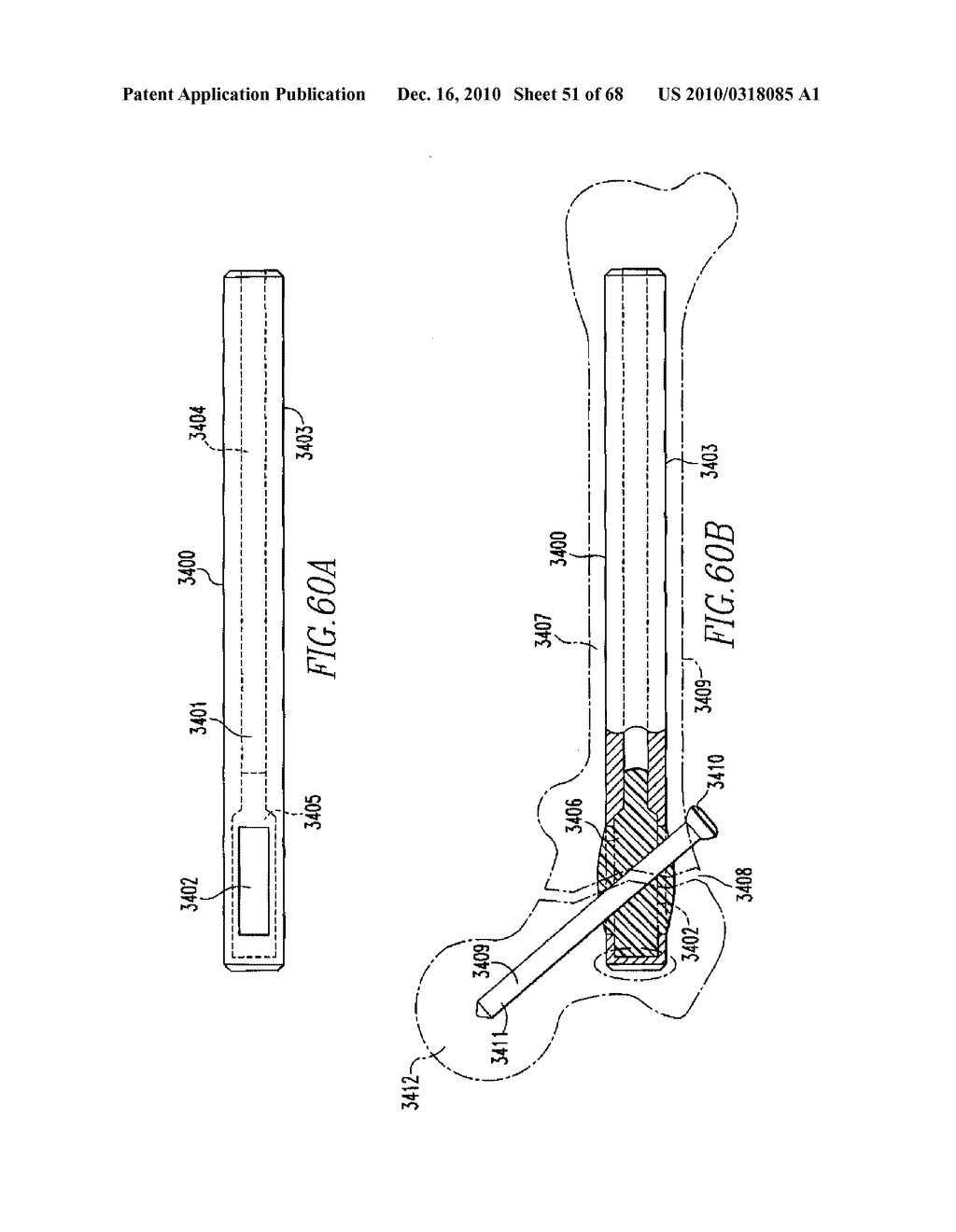 INTERNAL FIXATION DEVICES - diagram, schematic, and image 52