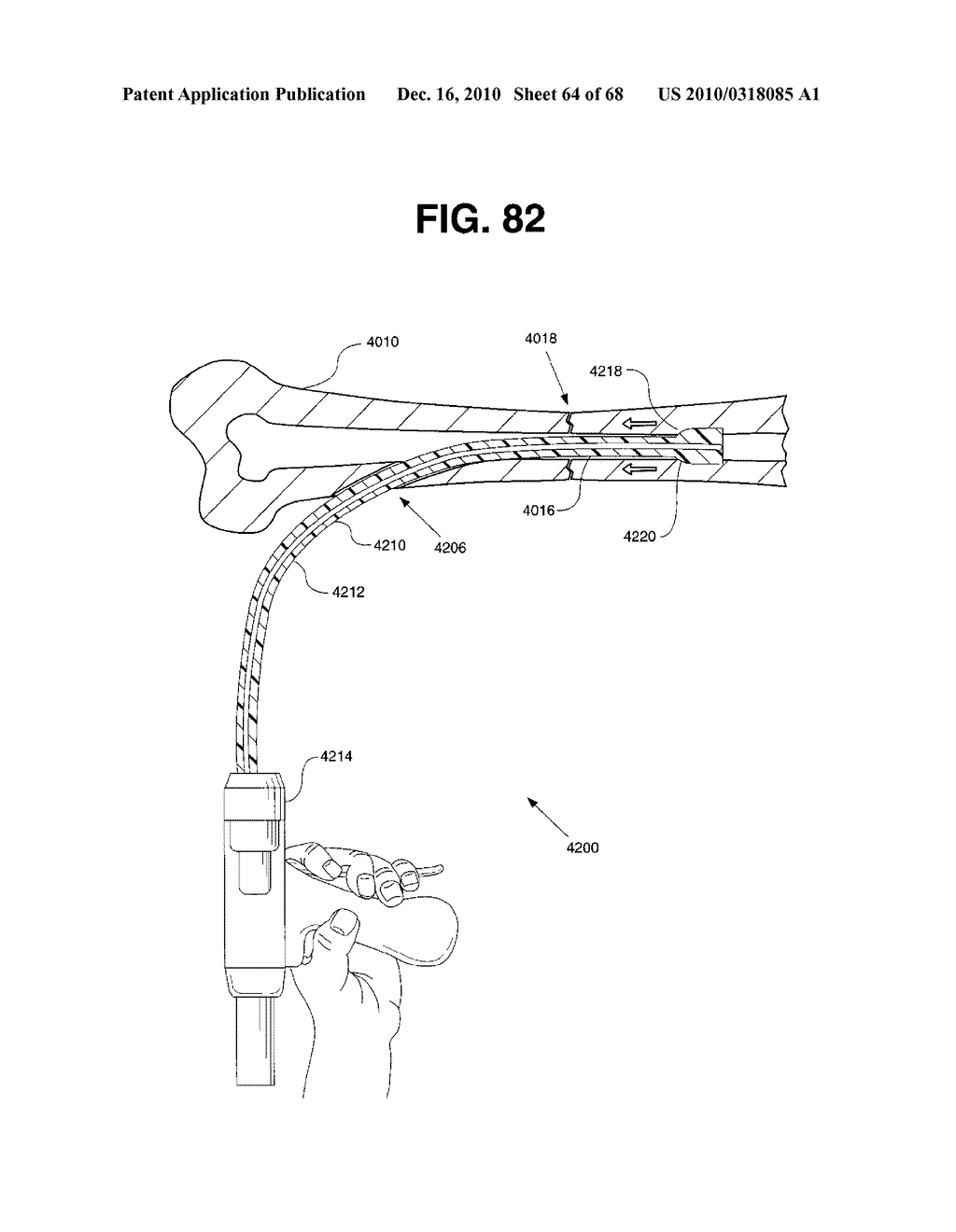 INTERNAL FIXATION DEVICES - diagram, schematic, and image 65