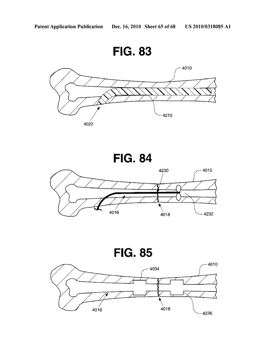 INTERNAL FIXATION DEVICES - diagram, schematic, and image 66