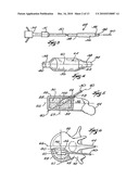 SYSTEMS AND METHODS FOR FORMING A CAVITY IN CANCELLOUS BONE diagram and image