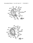 SYSTEMS AND METHODS FOR FORMING A CAVITY IN CANCELLOUS BONE diagram and image