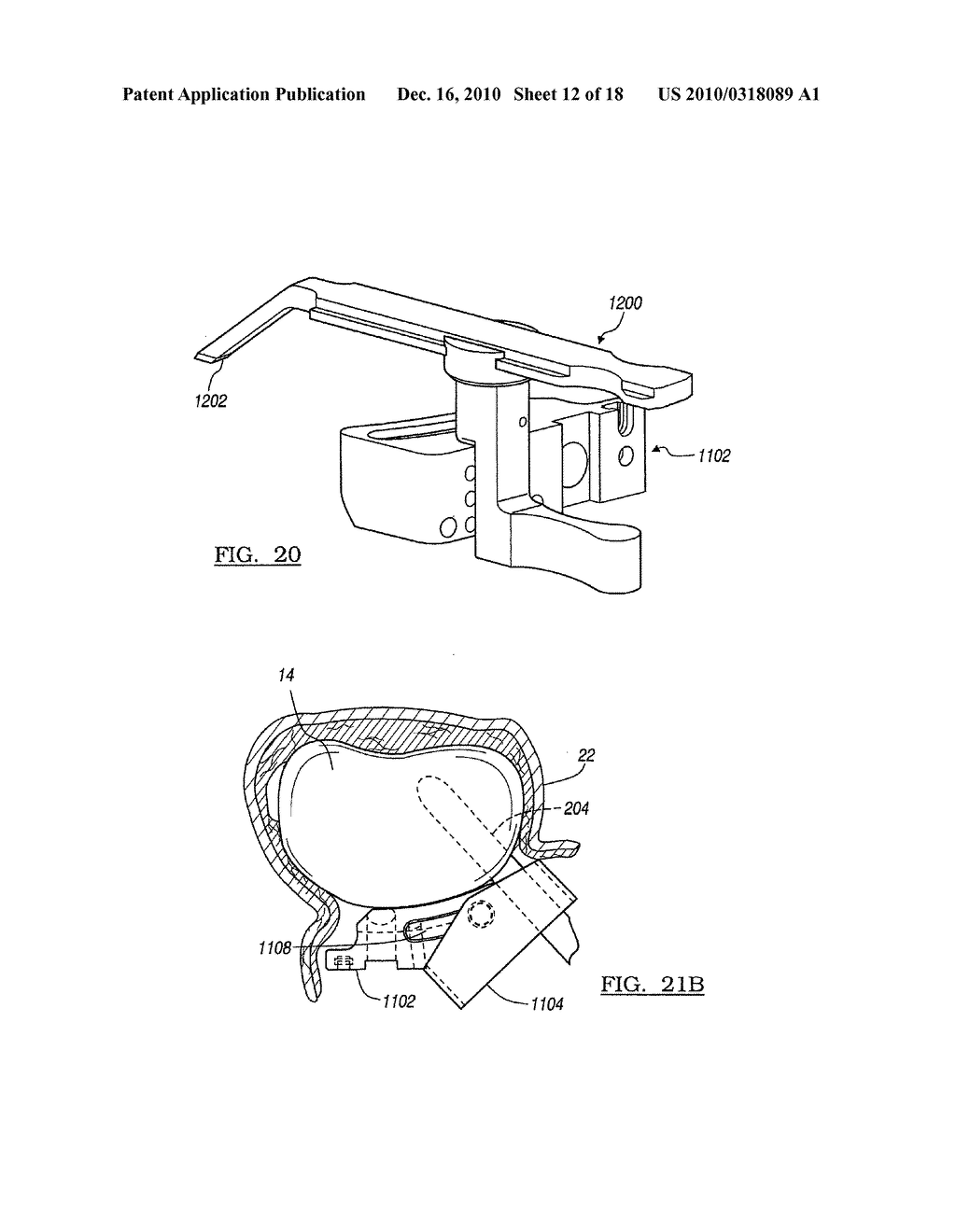 METHOD AND APPARATUS FOR LESS INVASIVE KNEE RESECTION - diagram, schematic, and image 13