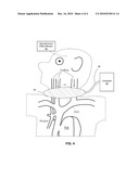 Venous Modulation of Collateral Perfusion of Cerebral Ischemia diagram and image