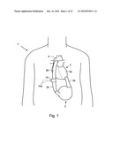 BLOOD CLOT REMOVAL DEVICE, SYSTEM, AND METHOD diagram and image