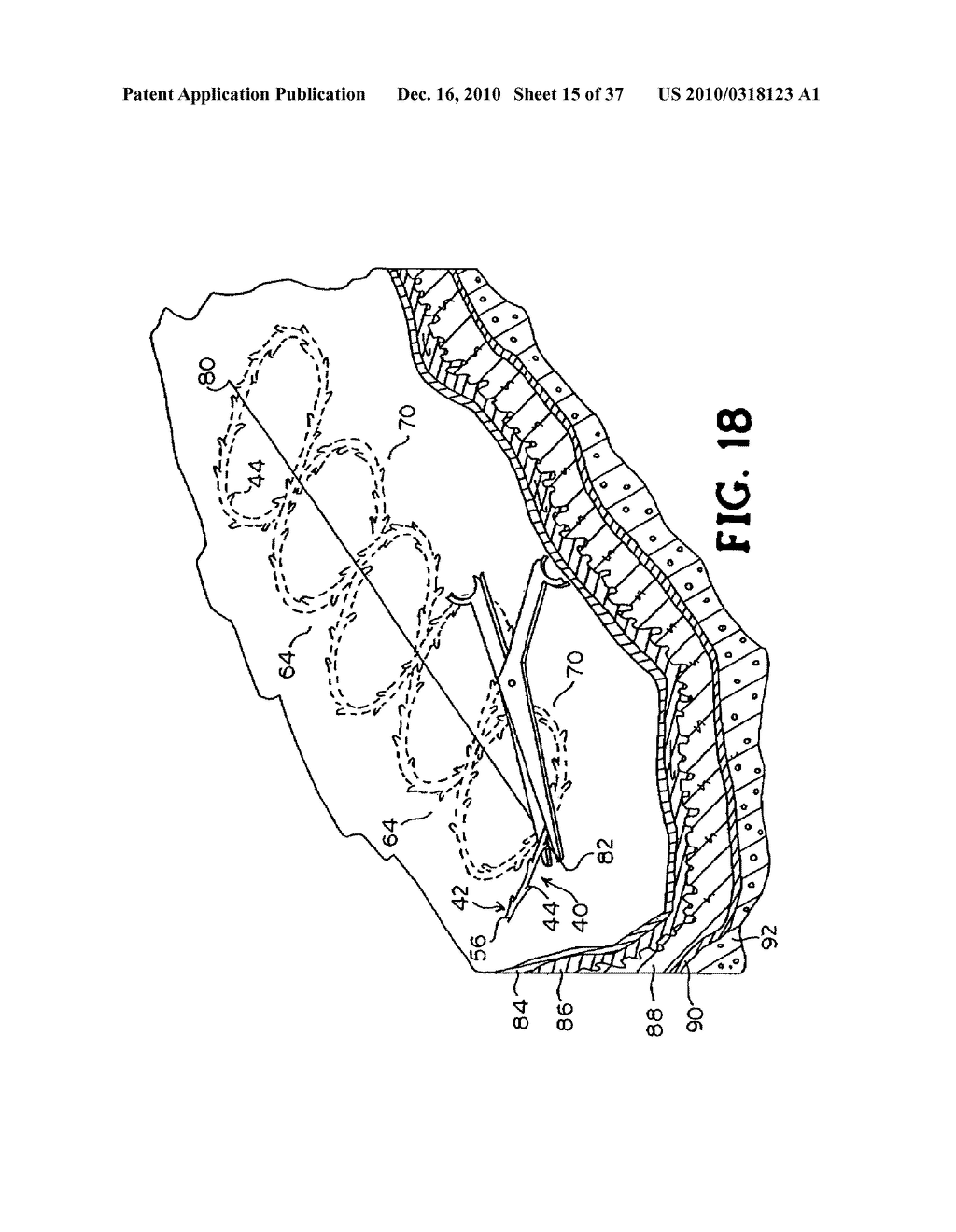 CONTINUOUS METHOD ANASTOMOSIS USING SELF-RETAINING SUTURES - diagram, schematic, and image 16