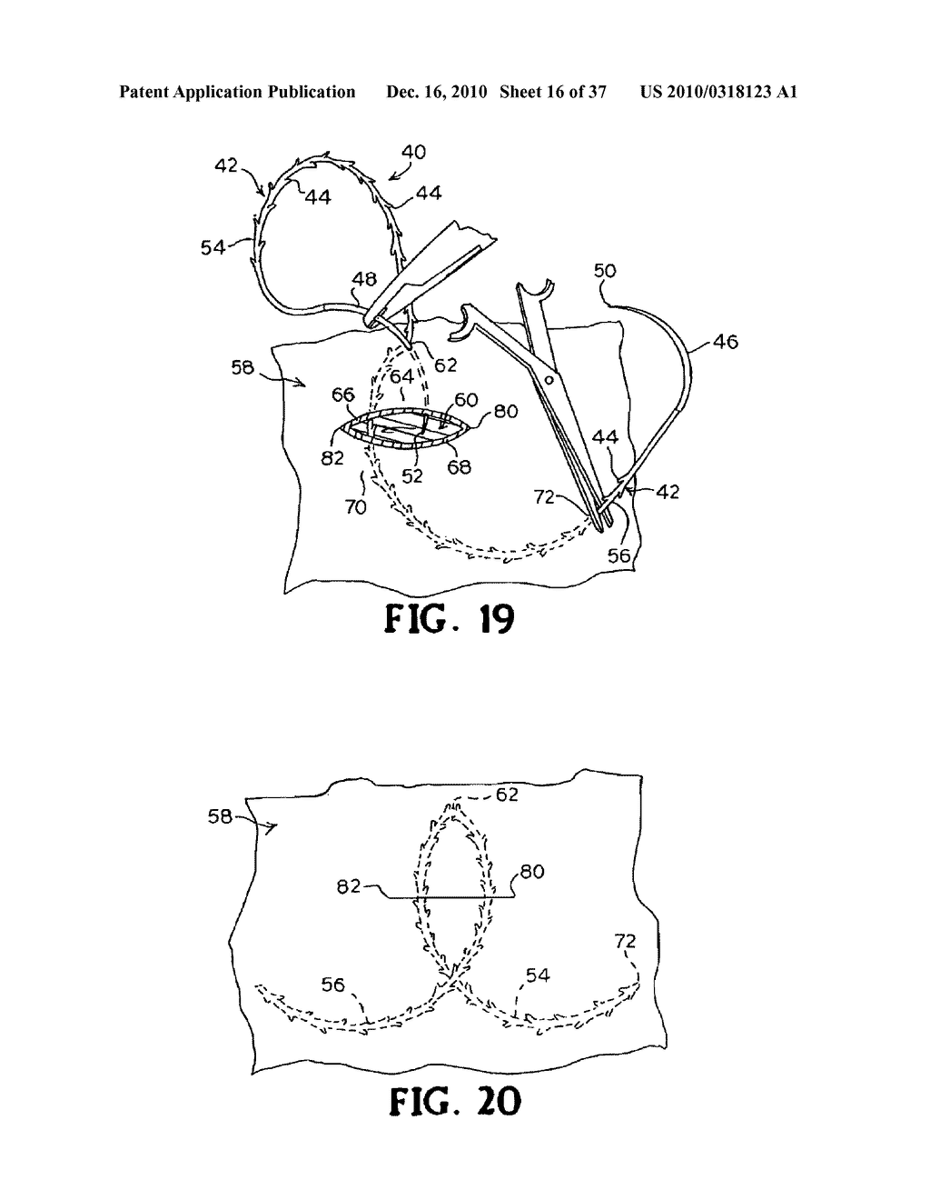 CONTINUOUS METHOD ANASTOMOSIS USING SELF-RETAINING SUTURES - diagram, schematic, and image 17