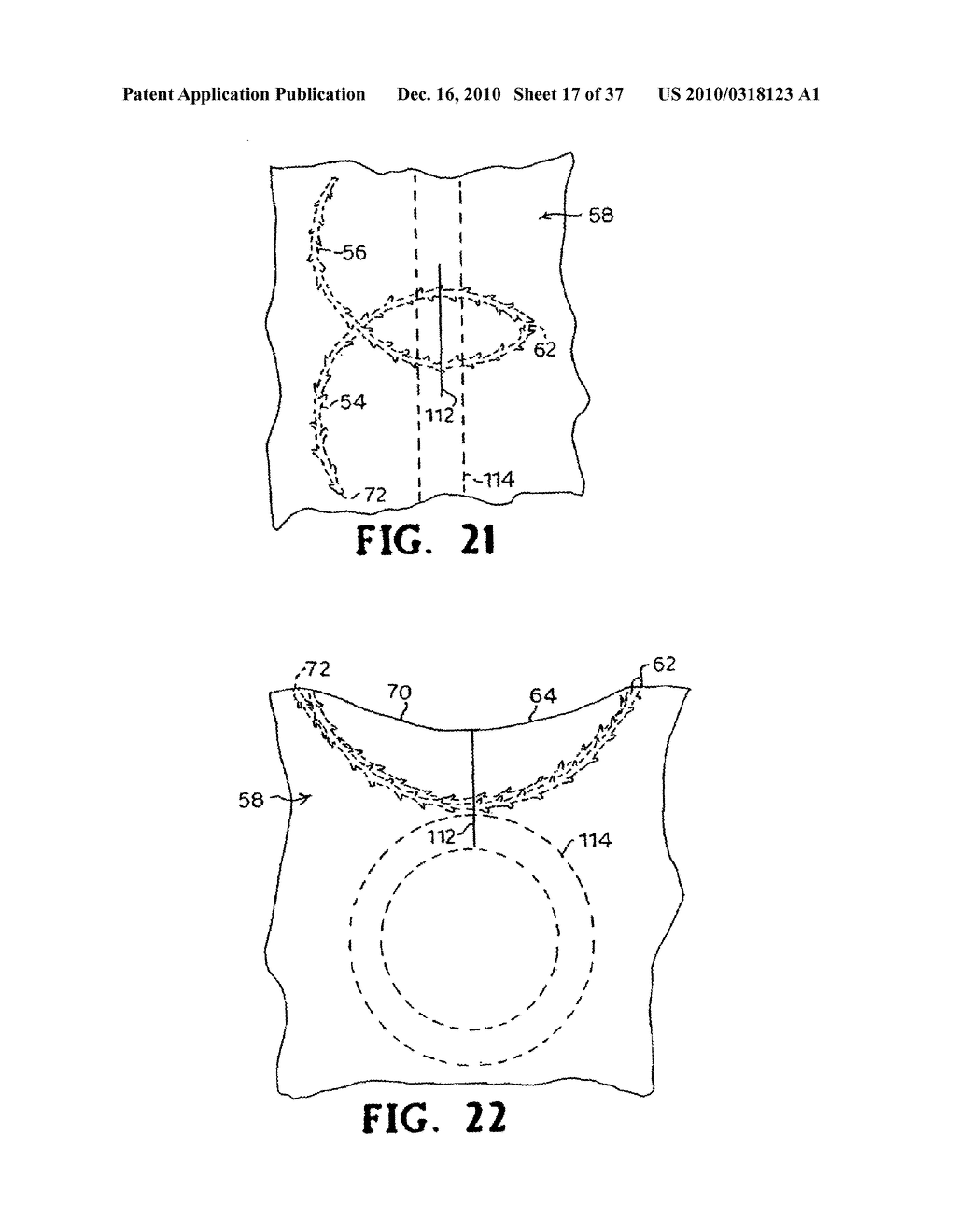 CONTINUOUS METHOD ANASTOMOSIS USING SELF-RETAINING SUTURES - diagram, schematic, and image 18