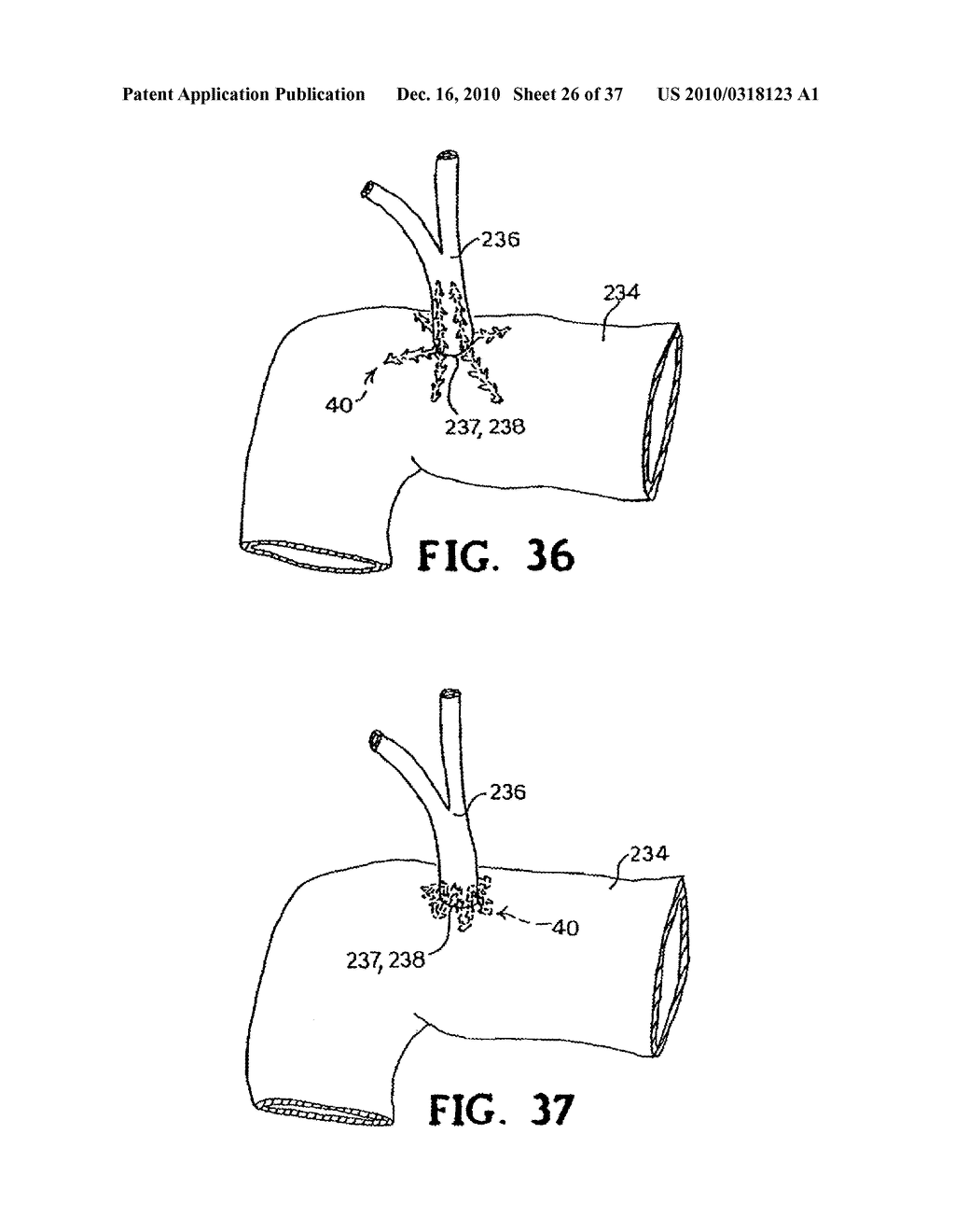 CONTINUOUS METHOD ANASTOMOSIS USING SELF-RETAINING SUTURES - diagram, schematic, and image 27