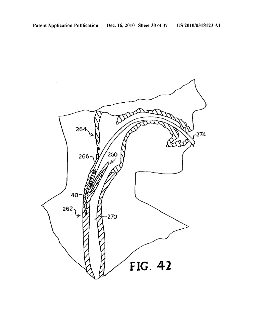 CONTINUOUS METHOD ANASTOMOSIS USING SELF-RETAINING SUTURES - diagram, schematic, and image 31