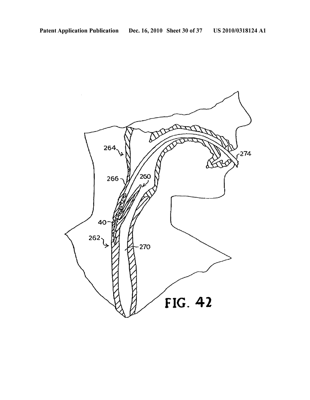 SUBCUTANEOUS SINUSOIDAL WOUND CLOSURE UTILIZING ONE-WAY SUTURE - diagram, schematic, and image 31