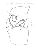 Method and apparatus for detecting imminent structural failure of an electrical lead in an implanted cardiac therapy medical device diagram and image