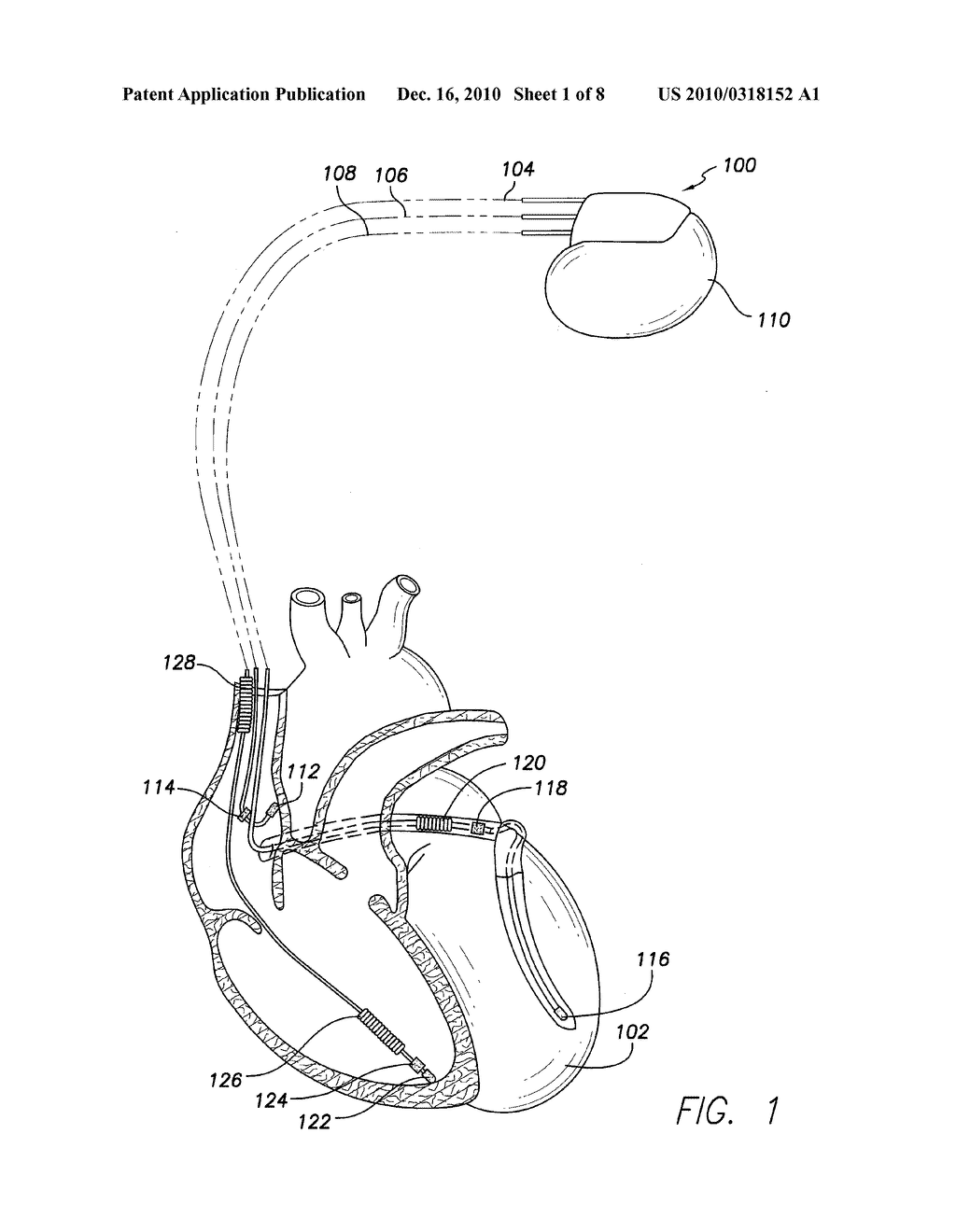 METHOD AND SYSTEM FOR OVERDRIVING A HEART CHAMBER DURING A THRESHOLD SEARCH - diagram, schematic, and image 02