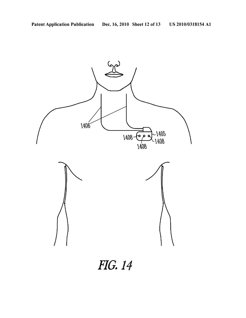 SYSTEM AND METHOD FOR TESTING NEURAL STIMULATION THRESHOLD - diagram, schematic, and image 13