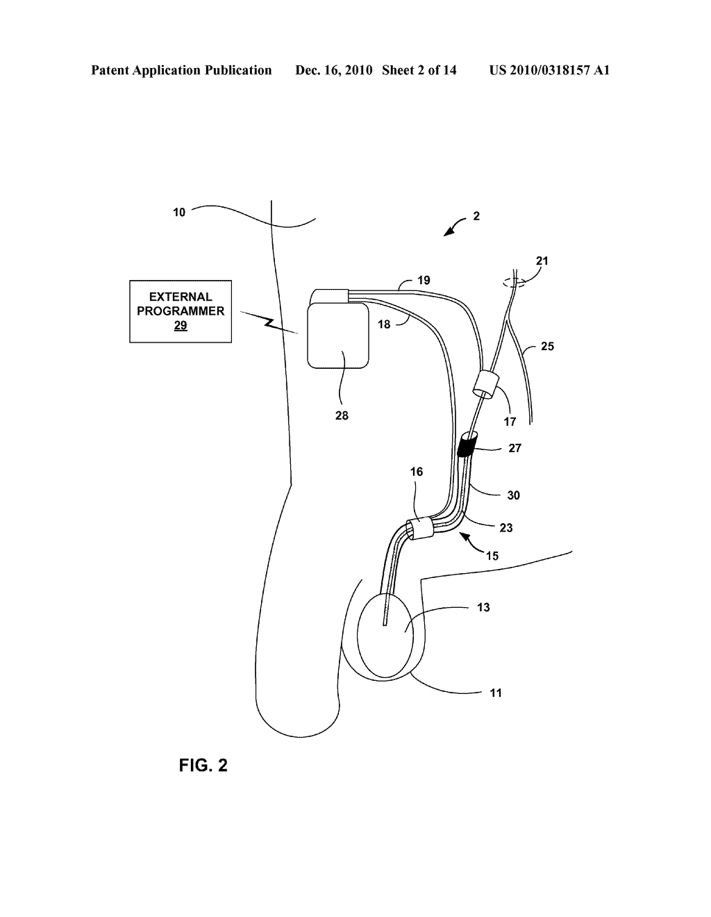 ELECTRICAL STIMULATION TO ALLEVIATE CHRONIC PELVIC PAIN - diagram, schematic, and image 03