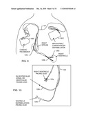 MULTIPLEXER FOR SELECTION OF AN MRI COMPATIBLE BANDSTOP FILTER PLACED IN SERIES WITH A PARTICULAR THERAPY ELECTRODE OF AN ACTIVE IMPLANTABLE MEDICAL DEVICE diagram and image