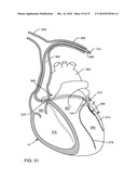 MULTIPLEXER FOR SELECTION OF AN MRI COMPATIBLE BANDSTOP FILTER PLACED IN SERIES WITH A PARTICULAR THERAPY ELECTRODE OF AN ACTIVE IMPLANTABLE MEDICAL DEVICE diagram and image