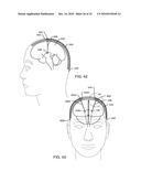 MULTIPLEXER FOR SELECTION OF AN MRI COMPATIBLE BANDSTOP FILTER PLACED IN SERIES WITH A PARTICULAR THERAPY ELECTRODE OF AN ACTIVE IMPLANTABLE MEDICAL DEVICE diagram and image