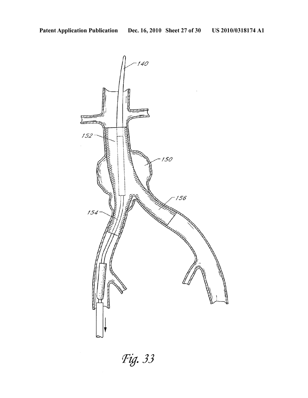 IMPLANTABLE VASCULAR GRAFT - diagram, schematic, and image 28