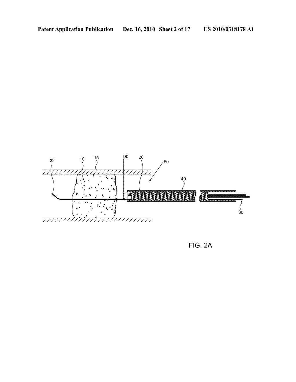 METHOD AND APPARATUS FOR ALLOWING BLOOD FLOW THROUGH AN OCCLUDED VESSEL - diagram, schematic, and image 03