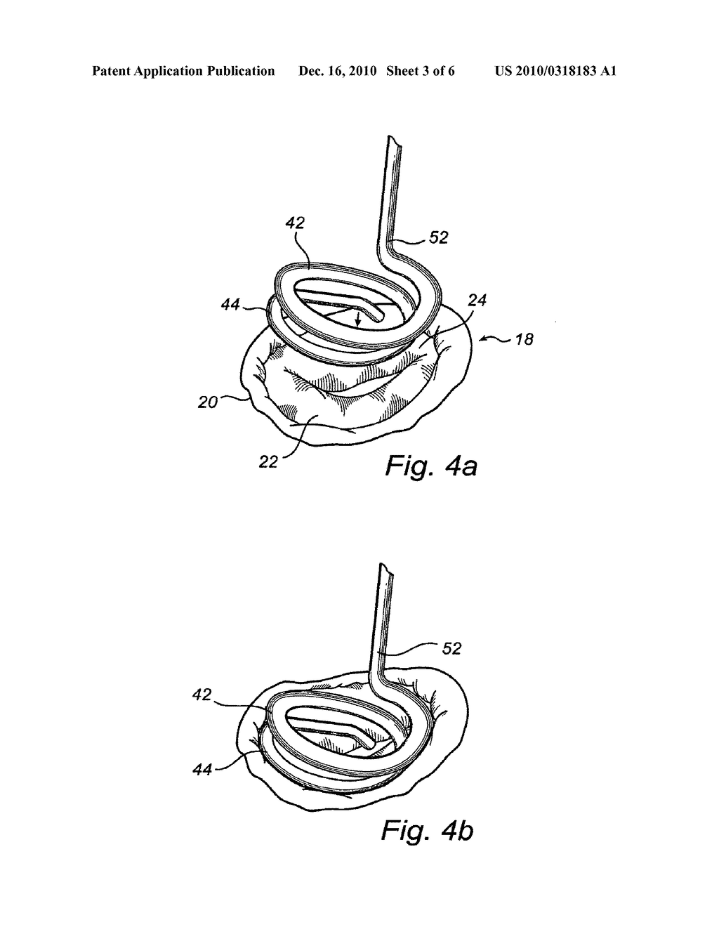 System For Improving The Function Of A Heart Valve - diagram, schematic, and image 04