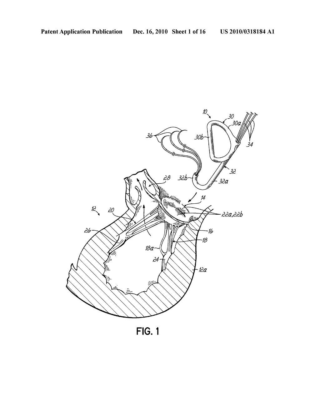 HEART VALVE REPAIR APPARATUS AND METHODS - diagram, schematic, and image 02