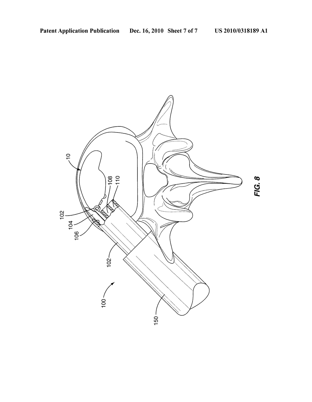 Expandable Intervertebral Spacers and Methods of Use - diagram, schematic, and image 08